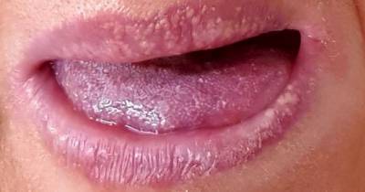 Small bumps on tongue could be latest coronavirus symptom, doctors warn - dailystar.co.uk - Spain - Britain - city London - city Madrid, Spain