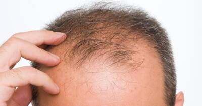 Hair loss appearing in Covid sufferers months after infection - dailyrecord.co.uk - Usa - state Indiana - Turkey