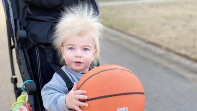 Georgia toddler diagnosed with extremely rare uncombable hair syndrome - fox29.com - city Atlanta - Georgia