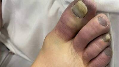 What are Covid toes and how are they caused? Everything you need to know - livemint.com - India - state Connecticut