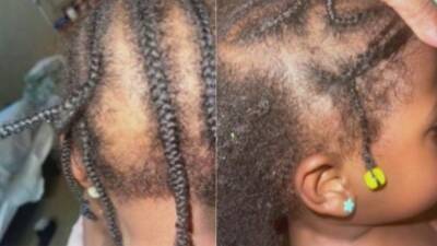 Duluth mother claims daycare workers ripped braids out of toddlers scalp - fox29.com - Georgia