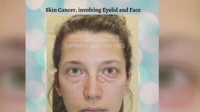 Woman shares skin cancer warning signs after undergoing extensive plastic surgery - fox29.com - city Houston