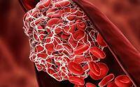 COVID patients may be at higher risk for blood clots for up to 6 months - cidrap.umn.edu - Sweden