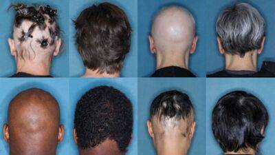 Eli Lilly - FDA approves 1st drug treatment for alopecia hair loss - fox29.com