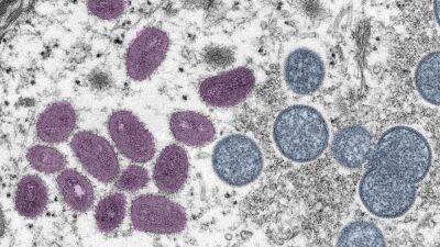 Wisconsin's 1st monkeypox case identified, DHS says - fox29.com - state Wisconsin - county Dane