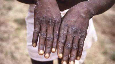 WHO declares Monkeypox outbreak a global public health emergency - livemint.com - Usa - India - Central African Republic