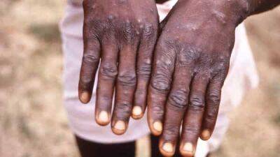Adhanom Ghebreyesus - In a first, a man infected with Covid, monkeypox at the same time - livemint.com - Usa - India - Central African Republic - region European
