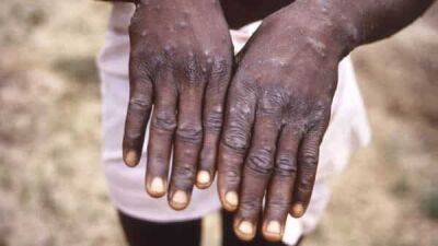 Explainer: How worried should we be about the monkeypox global health emergency? - livemint.com - India - state Massachusets