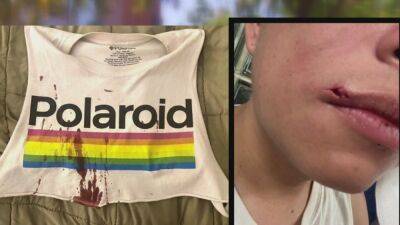 Gay couple attacked, accused of having monkeypox in Northwest DC - fox29.com - Washington