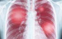 40% of COVID pneumonia patients still had lung problems at 1 year - cidrap.umn.edu - Spain