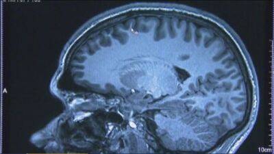 Experimental brain implant zaps patients, quells food cravings, helps with binge eating - fox29.com