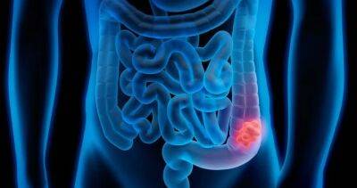 Colorectal cancer cases rising among younger adults in Canada and U.S. - globalnews.ca - Usa - Canada - county Holmes