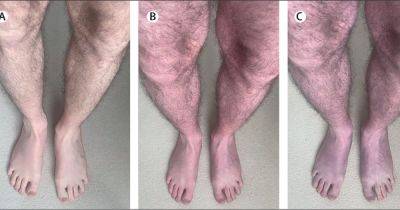 Rare Long Covid symptom identified as man's legs turn purple after standing up - dailyrecord.co.uk